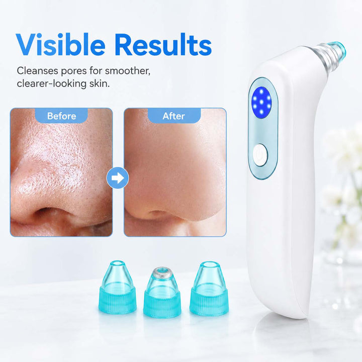 ML001 Blackhead Remover